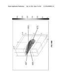 Blood Vessel Treatment with Pressure Shock Waves diagram and image