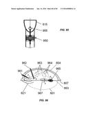 Blood Vessel Treatment with Pressure Shock Waves diagram and image