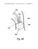 DEVICES, SYSTEMS AND METHODS FOR DIAGNOSING AND TREATING SINUSITIS AND     OTHER DISORDERS OF THE EARS, NOSE, AND/OR THROAT diagram and image