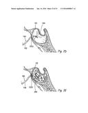 DEVICES, SYSTEMS AND METHODS FOR DIAGNOSING AND TREATING SINUSITIS AND     OTHER DISORDERS OF THE EARS, NOSE, AND/OR THROAT diagram and image