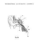 DEVICES, SYSTEMS AND METHODS FOR DIAGNOSING AND TREATING SINUSITIS AND     OTHER DISORDERS OF THE EARS, NOSE, AND/OR THROAT diagram and image