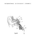 DEVICES, SYSTEMS AND METHODS FOR DIAGNOSING AND TREATING SINUSITIS AND     OTHER DISORDERS OF THE EARS, NOSE, AND/OR THROAT diagram and image