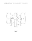 RENAL DENERVATION WITH STAGED ASSESSMENT diagram and image