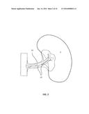 RENAL DENERVATION WITH STAGED ASSESSMENT diagram and image