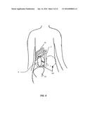 RENAL DENERVATION WITH STAGED ASSESSMENT diagram and image