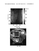 RENAL DENERVATION WITH STAGED ASSESSMENT diagram and image