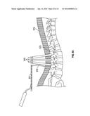 MINIMALLY INVASIVE PEDICLE SCREW EXTENSION SLEEVE SYSTEM diagram and image