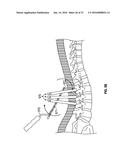 MINIMALLY INVASIVE PEDICLE SCREW EXTENSION SLEEVE SYSTEM diagram and image