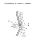 MINIMALLY INVASIVE PEDICLE SCREW EXTENSION SLEEVE SYSTEM diagram and image