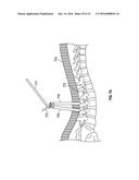 MINIMALLY INVASIVE PEDICLE SCREW EXTENSION SLEEVE SYSTEM diagram and image