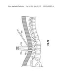 MINIMALLY INVASIVE PEDICLE SCREW EXTENSION SLEEVE SYSTEM diagram and image