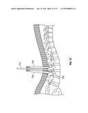 MINIMALLY INVASIVE PEDICLE SCREW EXTENSION SLEEVE SYSTEM diagram and image