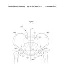 HIP JOINT DEVICE AND METHOD diagram and image