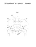 HIP JOINT DEVICE AND METHOD diagram and image