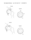 HIP JOINT DEVICE AND METHOD diagram and image