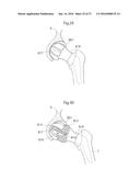 HIP JOINT DEVICE AND METHOD diagram and image