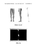 Kinematic Alignment and Novel Femoral and Tibial Prosthetics diagram and image