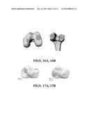 Kinematic Alignment and Novel Femoral and Tibial Prosthetics diagram and image