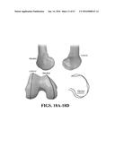 Kinematic Alignment and Novel Femoral and Tibial Prosthetics diagram and image