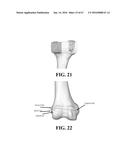 Kinematic Alignment and Novel Femoral and Tibial Prosthetics diagram and image