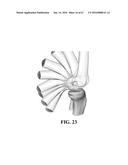 Kinematic Alignment and Novel Femoral and Tibial Prosthetics diagram and image