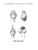 Kinematic Alignment and Novel Femoral and Tibial Prosthetics diagram and image