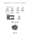 Kinematic Alignment and Novel Femoral and Tibial Prosthetics diagram and image