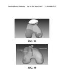 Kinematic Alignment and Novel Femoral and Tibial Prosthetics diagram and image