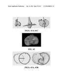 Kinematic Alignment and Novel Femoral and Tibial Prosthetics diagram and image