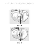 Kinematic Alignment and Novel Femoral and Tibial Prosthetics diagram and image