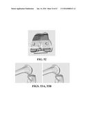 Kinematic Alignment and Novel Femoral and Tibial Prosthetics diagram and image