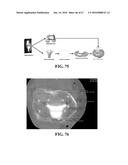 Kinematic Alignment and Novel Femoral and Tibial Prosthetics diagram and image