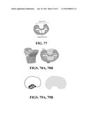 Kinematic Alignment and Novel Femoral and Tibial Prosthetics diagram and image