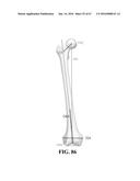 Kinematic Alignment and Novel Femoral and Tibial Prosthetics diagram and image