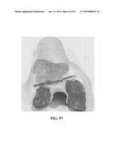 Kinematic Alignment and Novel Femoral and Tibial Prosthetics diagram and image