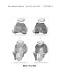 Kinematic Alignment and Novel Femoral and Tibial Prosthetics diagram and image