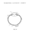 NASOLACRIMAL DRAINAGE SYSTEM IMPLANTS FOR DRUG THERAPY diagram and image