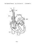 DUAL LUMEN CANNULA FOR ARTIFICIAL LUNG AND RIGHT VENTRICULAR ASSIST DEVICE diagram and image