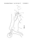 MEDICAL VALVE WITH A VARIABLE DIAMETER SEAL diagram and image