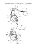 HYBRID SYSTEM FORMING AN ACTIVE IMPLANTABLE MEDICAL DEVICE diagram and image