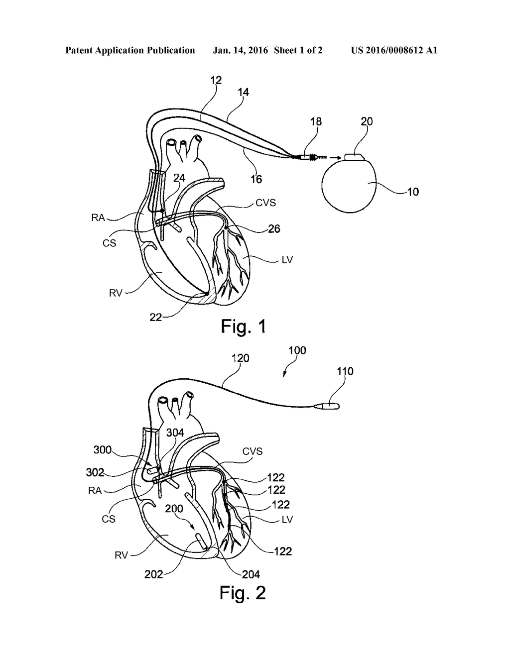 HYBRID SYSTEM FORMING AN ACTIVE IMPLANTABLE MEDICAL DEVICE - diagram, schematic, and image 02