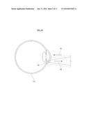 SYSTEMS AND METHODS FOR SENSING INTRAOCULAR PRESSURE diagram and image