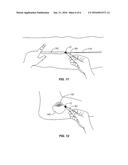 IMPREGNATED BRUSH APPLICATOR FOR MEDICAL ADHESIVES AND SEALANTS diagram and image