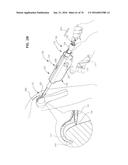 ARTHROSCOPIC SURGICAL DEVICE diagram and image