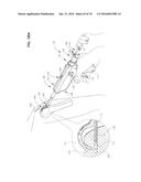 ARTHROSCOPIC SURGICAL DEVICE diagram and image