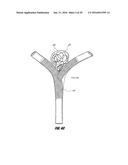 VASCULAR REMODELING DEVICE diagram and image