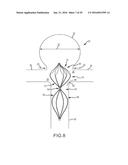 VASCULAR REMODELING DEVICE diagram and image