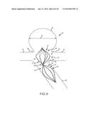 VASCULAR REMODELING DEVICE diagram and image