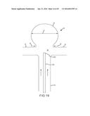 VASCULAR REMODELING DEVICE diagram and image