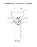 VASCULAR REMODELING DEVICE diagram and image